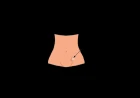 Inguinal Hernia: Classification, Clinical Features, and Surgical Management