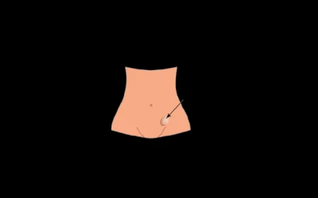 Inguinal Hernia: Classification, Clinical Features, and Surgical Management