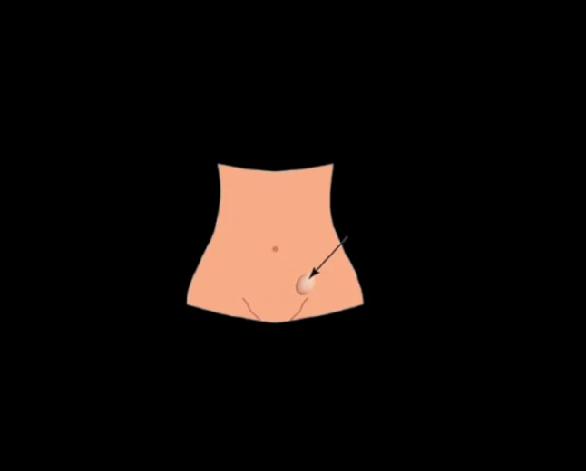 Inguinal Hernia: Classification, Clinical Features, and Surgical Management