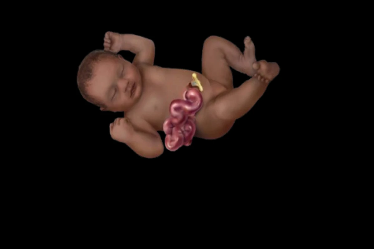 Understanding Gastroschisis: Causes, Pathology, Diagnosis, and Treatment