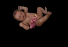 Understanding Gastroschisis: Causes, Pathology, Diagnosis, and Treatment