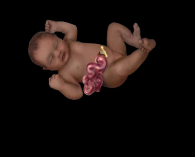 Understanding Gastroschisis: Causes, Pathology, Diagnosis, and Treatment