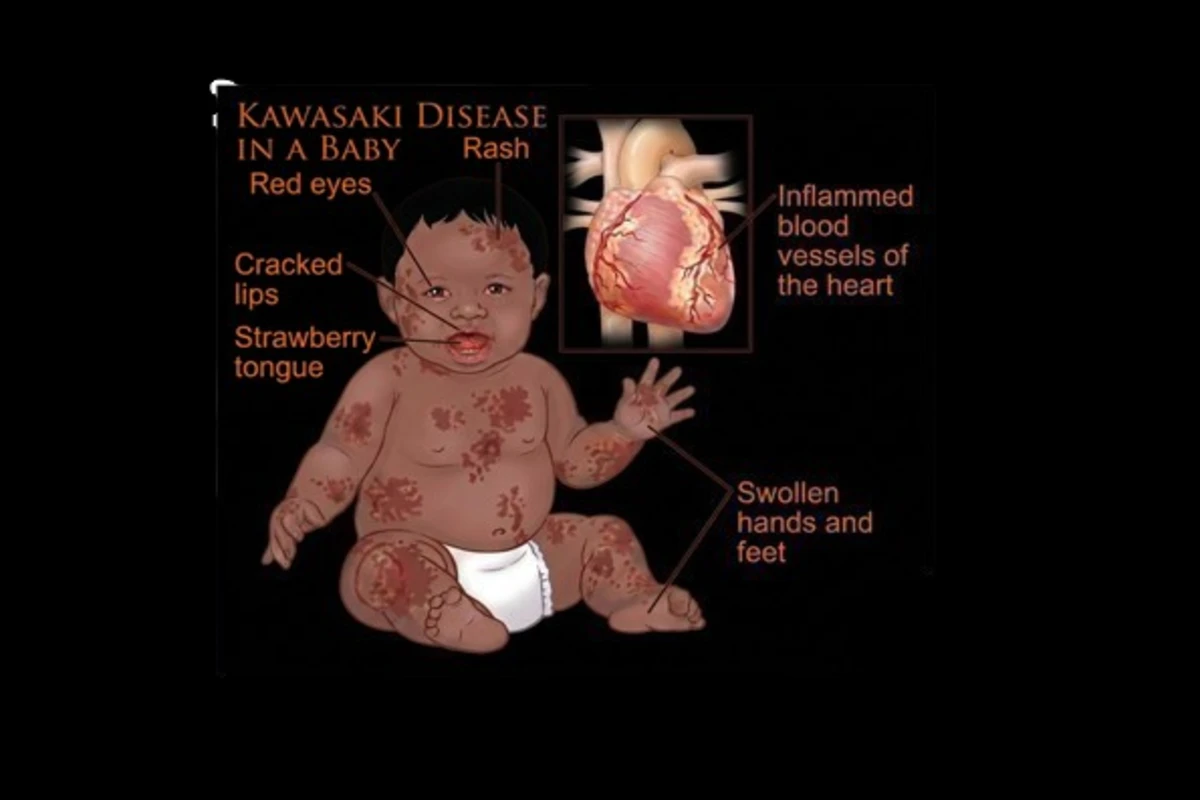 Kawasaki Disease in the Modern Era: An Evidence-Based Review of Diagnostic Criteria, Therapeutic Strategies, and Lifetime Cardiovascular Surveillance