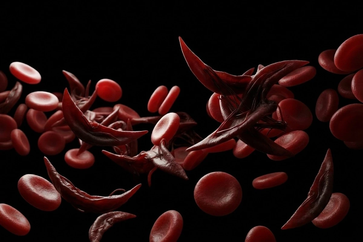 Sickle Cell Disease: A Comprehensive Clinical Guide to Pathophysiology, Diagnosis, and Management