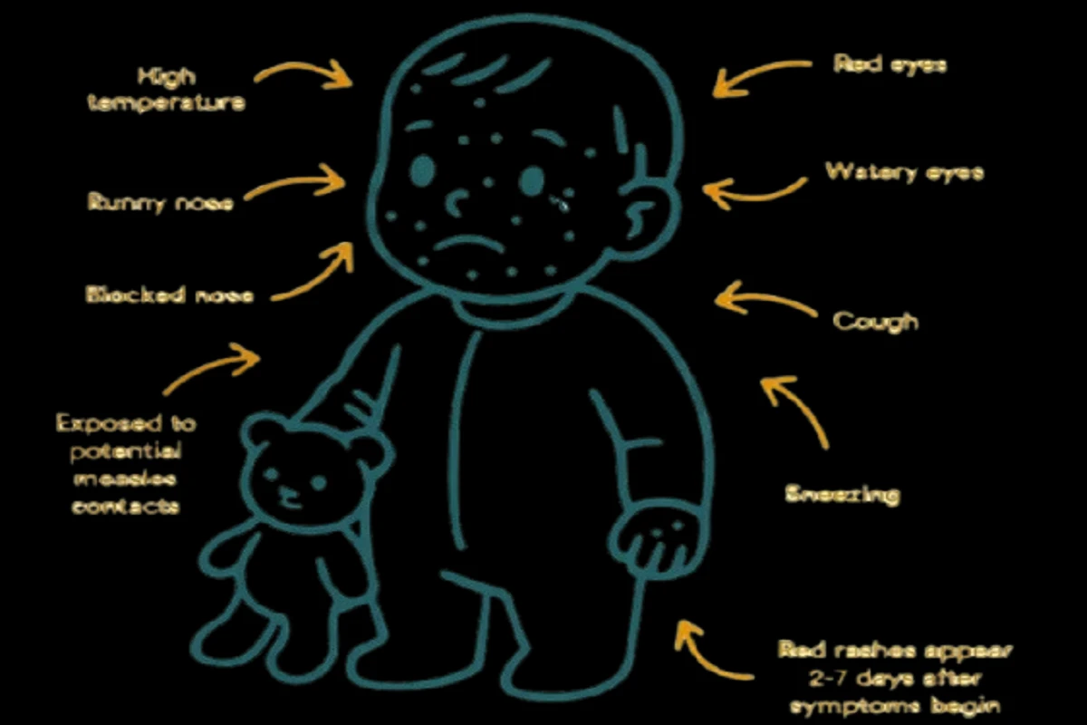Measles in the Modern Era: A Comprehensive Review for the Clinician on Diagnosis, Vaccination Strategies, and Management