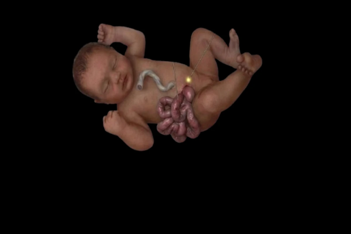 Understanding Gastroschisis: Causes, Pathology, Diagnosis, and Treatment