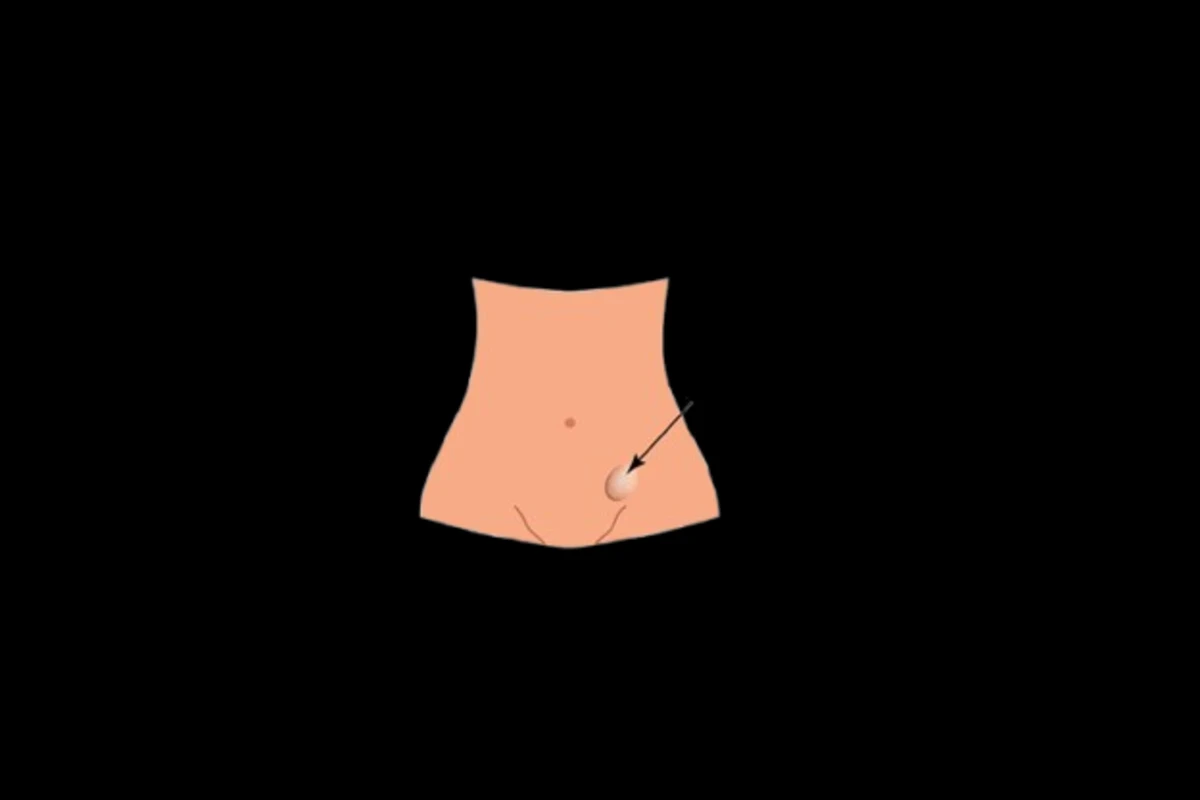 Inguinal Hernia: Classification, Clinical Features, and Surgical Management