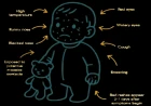 Measles in the Modern Era: A Comprehensive Review for the Clinician on Diagnosis, Vaccination Strategies, and Management
