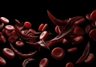 Sickle Cell Disease: A Comprehensive Clinical Guide to Pathophysiology, Diagnosis, and Management