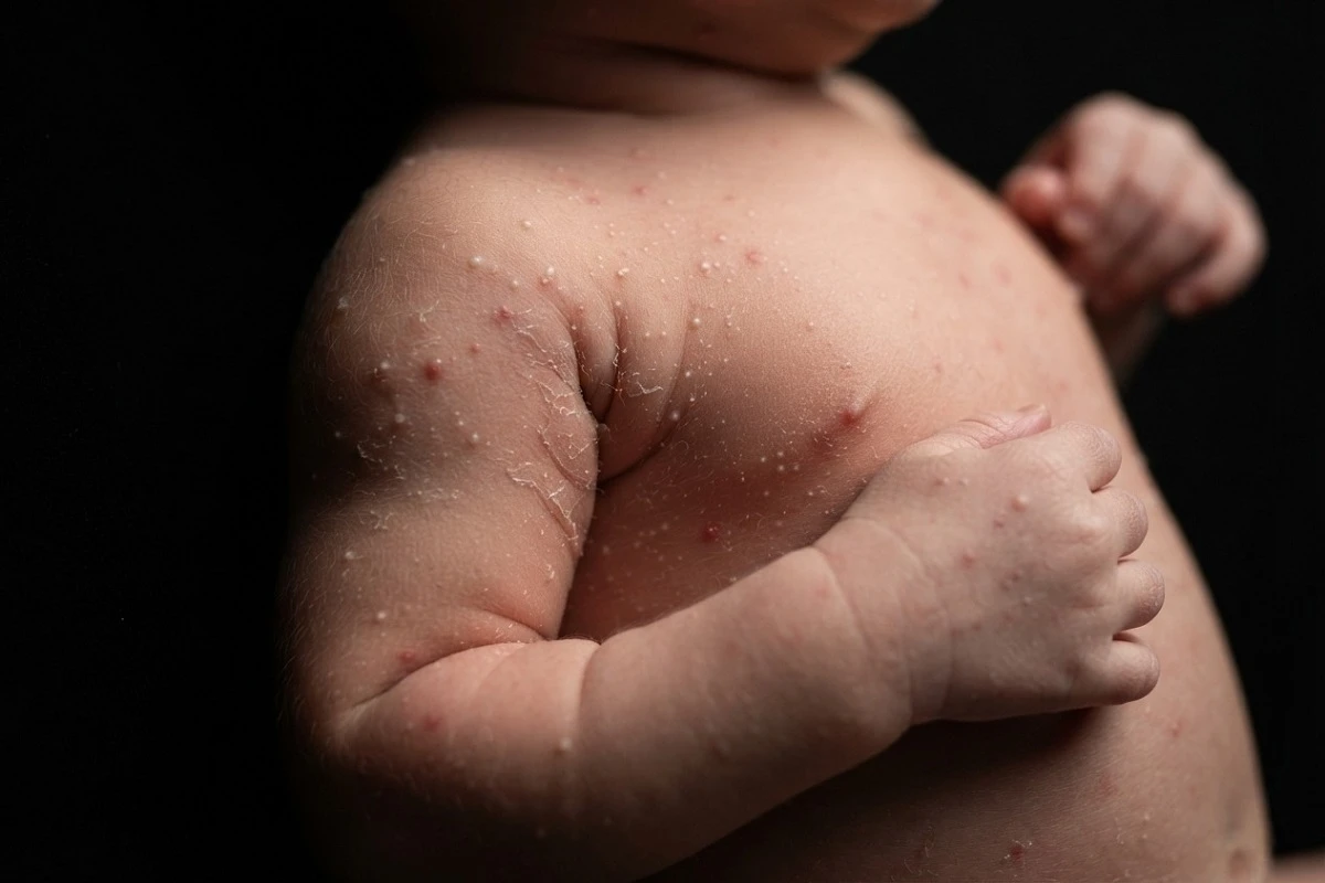 Neonatal and Infantile Dermatology: A Comprehensive Clinical Guide to Common Rashes and Skin Findings