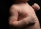 Neonatal and Infantile Dermatology: A Comprehensive Clinical Guide to Common Rashes and Skin Findings