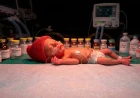 Surfactant Therapy in Newborns: A Complete Guide to Types, Timing, and Techniques of Administration