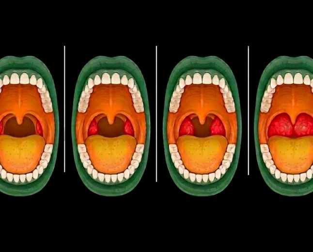 Recurrent Tonsillitis in Children: When Does a Sore Throat Become a Surgical Decision?